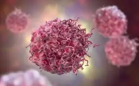 Karcinom orofarinksa je najčešći tip raka grla. Pojavljuje se u krajnicima i zadnjem delu grla, a u čak 70% slučajeva uzročnik je HPV virus.