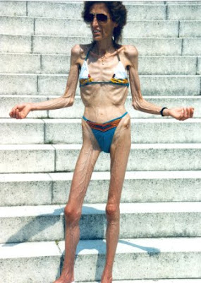 anorexic woman