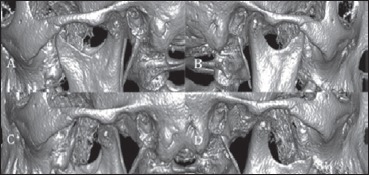 64-channel MDCT with multi-planar reconstructions (MPR) and 3D volumetric reconstructions (3D-VR). Left- (A) and right-sided view (B) of the temporomandibular joint (closed mouth). Left- (C) and right-sided view (D) of the temporomandibular joint (open mouth).