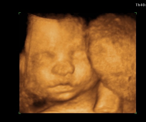 3d ultrasound 20 weeks pregnant. 3D Ultrasound – 28 weeks amp;