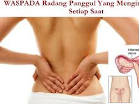 Obat Radang Panggul Alami Yang Ampuh dan Aman