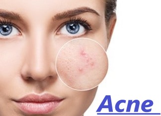 Acne -How to get rid of acne 