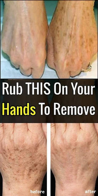 Rub THIS On Your Hands To Remove Dark Spots Fast