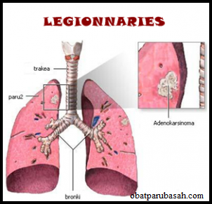 Penyakit Paru Paru Legionnaries