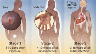 Antibiotik untuk sipilis pada pria tanpa mengandung bahan kimia