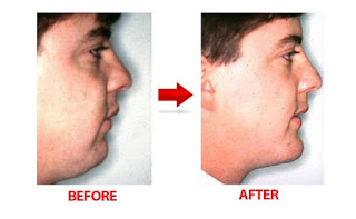 How to Lose Cheek Fat