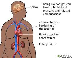 heart disease symptoms in women