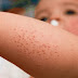 Niños pequeños sufrirán infecciones en la piel si no tratan a tiempo el sarpullido