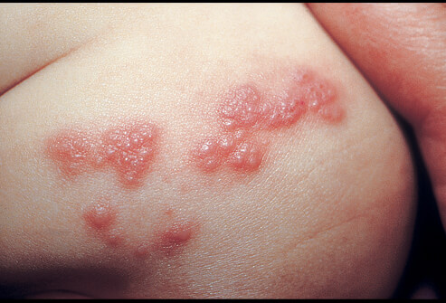 cara menyembuhkan herpes