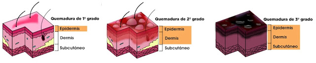 https://www.mdsaude.com/es/dermatologia-es/quemaduras/