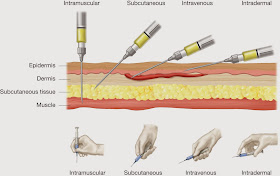 injections parentérales infirmier angle technique