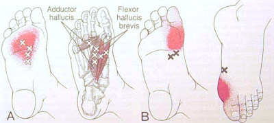 MIOTERAPIA - PONTO GATILHO - TRIGGER POINT 