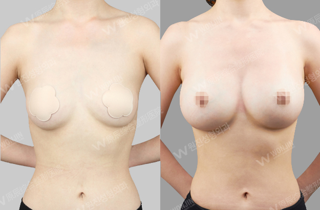 짱이뻐! - Before and After Photos Korean Breast Plastic Surgery