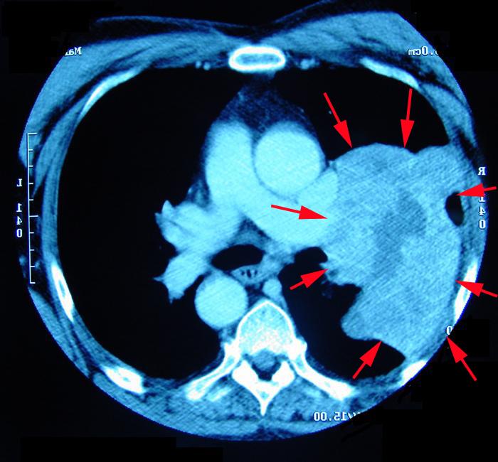 Lung cancer ~ Anatomy for MSP