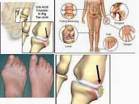 Cara Mengatasi Asam Urat Secara Cepat