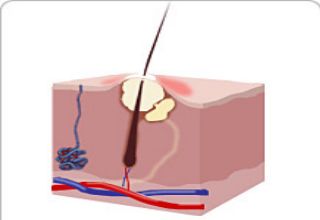 L'acné est une dermatose (maladie de la peau) inflammatoire des follicules pilosébacés (les glandes sécrétant le sébum, à la racine des poils) avec formation de comédons. Typiquement, elle commence à la puberté et touche principalement les adolescents, de façon plus ou moins sévère. Elle cesse spontanément, le plus souvent à la fin de l'adolescence.