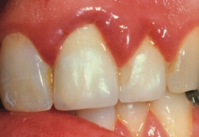 Nguyên nhân sưng nướu răng hàm trên