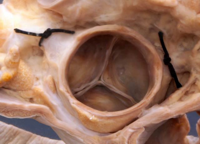 A horizontal section of the upper heart showing the anatomical relations of the tricuspid, mitral, aortic and pulmonary valves.