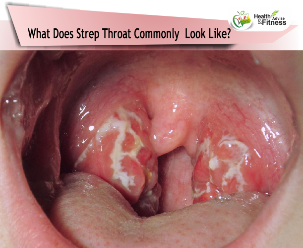 strep throat healthnfitnessadvise-com