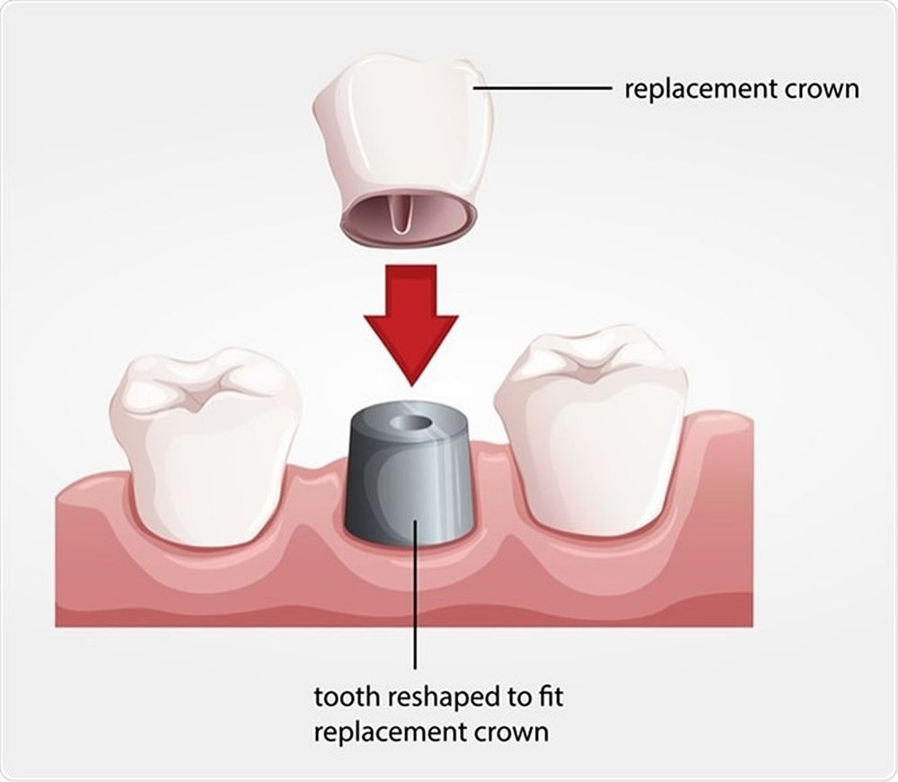 Dental Crown