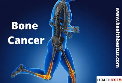 Bone Cancer - Health Best