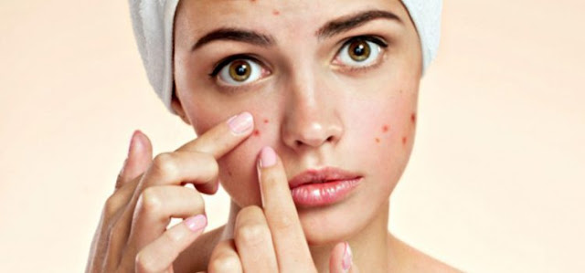 How to Remove Pimple Marks