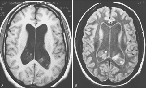 abnormal mri brain