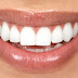 Los riesgos de una sonrisa muy blanca