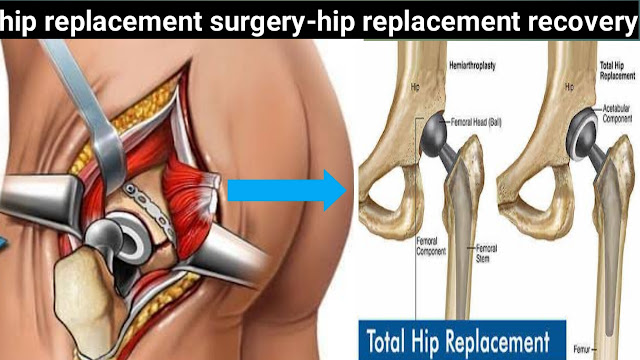 Best-hip-replacement-surgery-recovery-cost-age.png