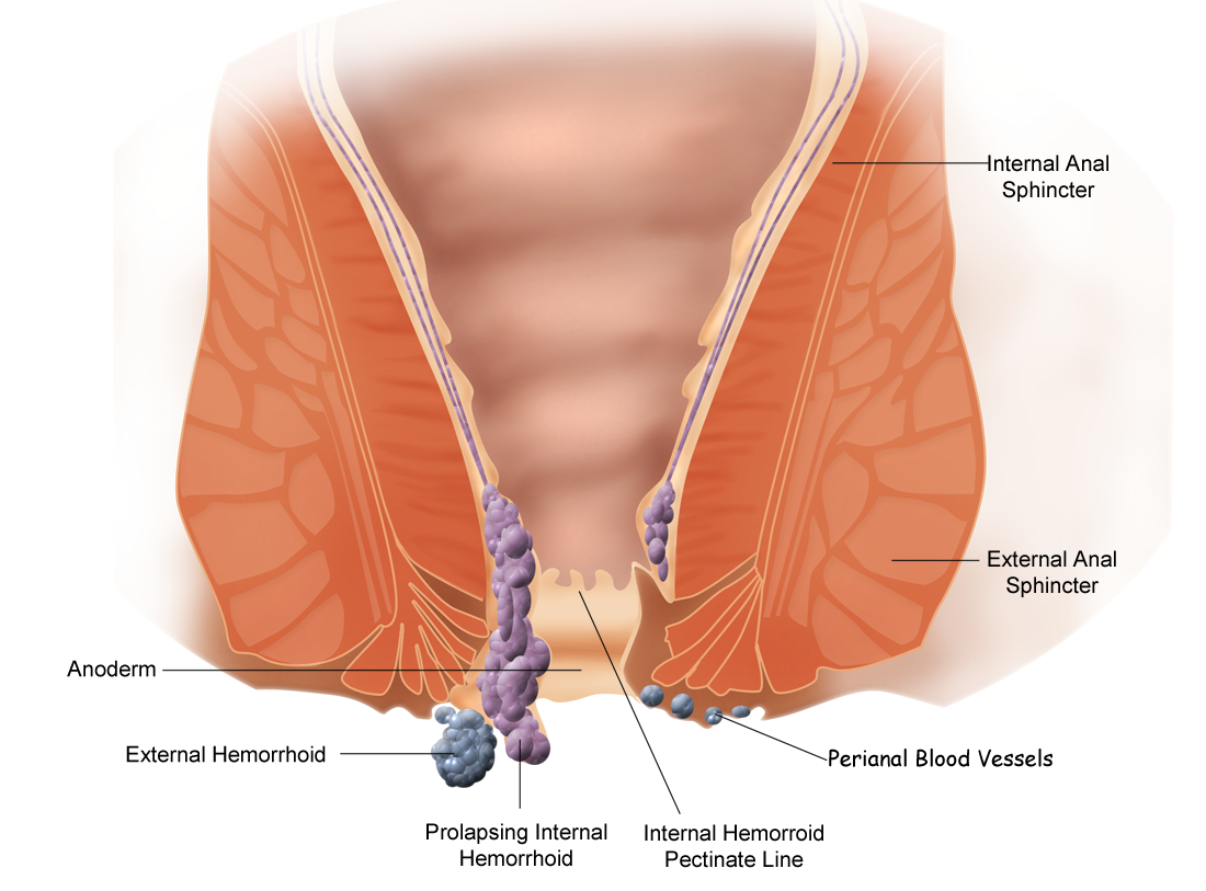 Treatment For External Hemorrhoid Can Be Done At Home Using Natural