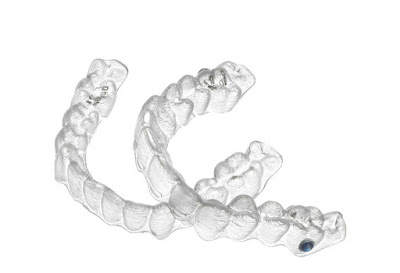 Niềng răng Invisalign như thế nào