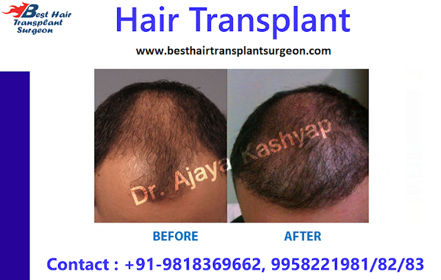 Hair Transplant