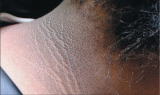 Acanthosis nigricans