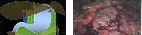 Chapitre 11 : Evaluation de la carcinose peritoneale