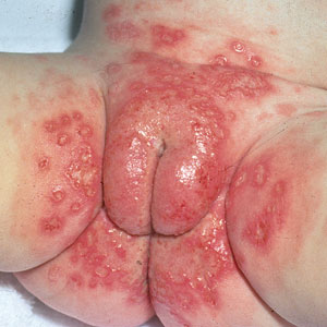 cara mengatasi penyakit herpes