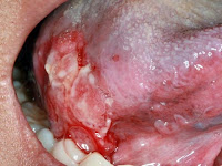 Tongue Cancer