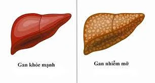 Nguyên nhân gây gan nhiễm mỡ là gì? Bệnh gan nhiễm mỡ có chữa được không?