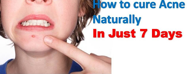 How to Prevent Pimples on Face Forever Naturally at Home in 7 Days