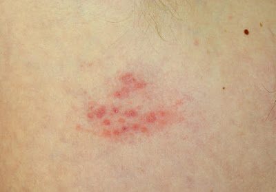 Eczema on Foreskin Symptoms, Causes, Treatment 