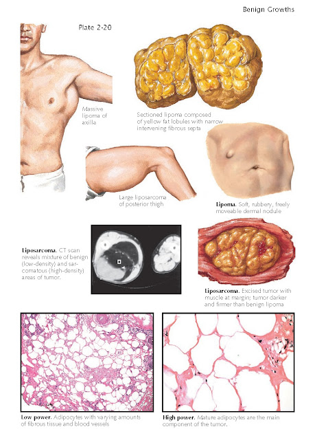 LIPOMA