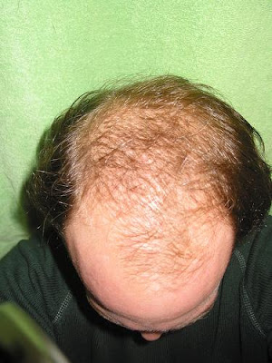 Hair Loss men