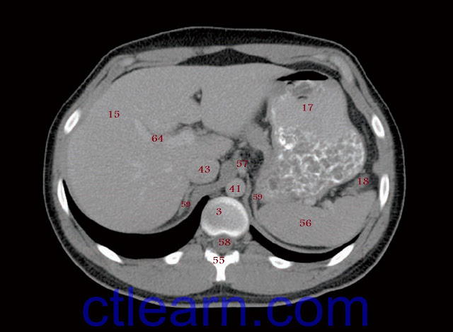 Male Abdomen and Pelvis CT Scan