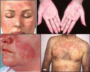 Cara Mengobati Awal Gejala Gatal Kulit Yang Terkena Herpes