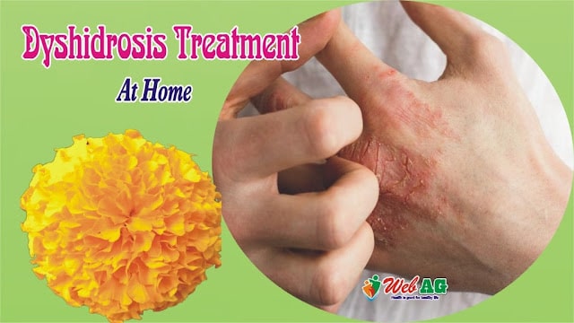 Dyshidrosis Treatment At Home | Dyshidrosis Home Treatment