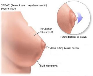 Sadari Lebih Awal Gejala Kanker Payudara