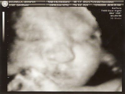 3d ultrasound pictures at 20 weeks. 35 Week 4 Day 3D Ultrasound by