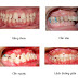 Nguyên nhân dẫn đến tình trạng răng bị lệch lạc