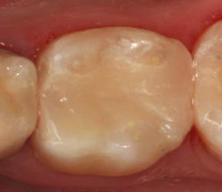 Boulder, CO patient's tooth after a dental restoration.