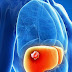 Types Of liver cancer - Symptoms of liver cancer - Treatment, causes, diagnosis.