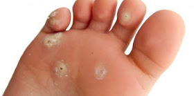 plantar wart